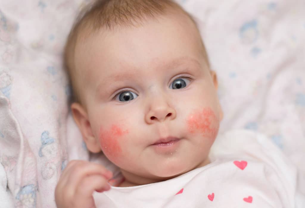 Common Allergies In Babies