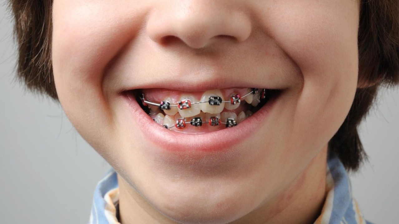 Orthodontic Options for Young Children