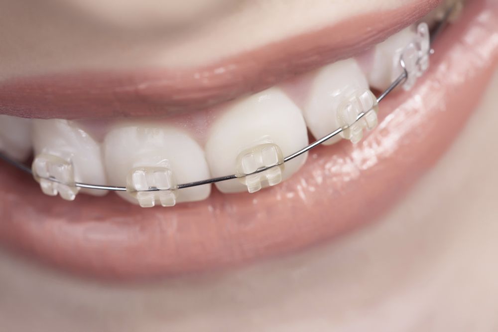 Orthodontic Options for Your Teenager (Ages 15+)