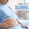 From Pain to Recovery: C-Section Scar Healing Stages