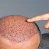 The Future of Hair Transplant: Asli Tarcan Clinic Launches Sagittal-Oblique Channel Method