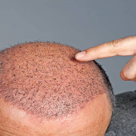The Future of Hair Transplant: Asli Tarcan Clinic Launches Sagittal-Oblique Channel Method
