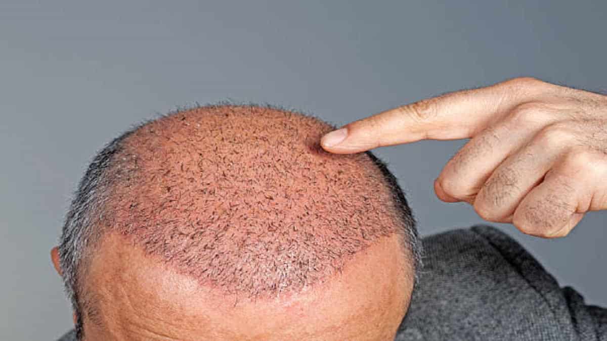 The Future of Hair Transplant: Asli Tarcan Clinic Launches Sagittal-Oblique Channel Method
