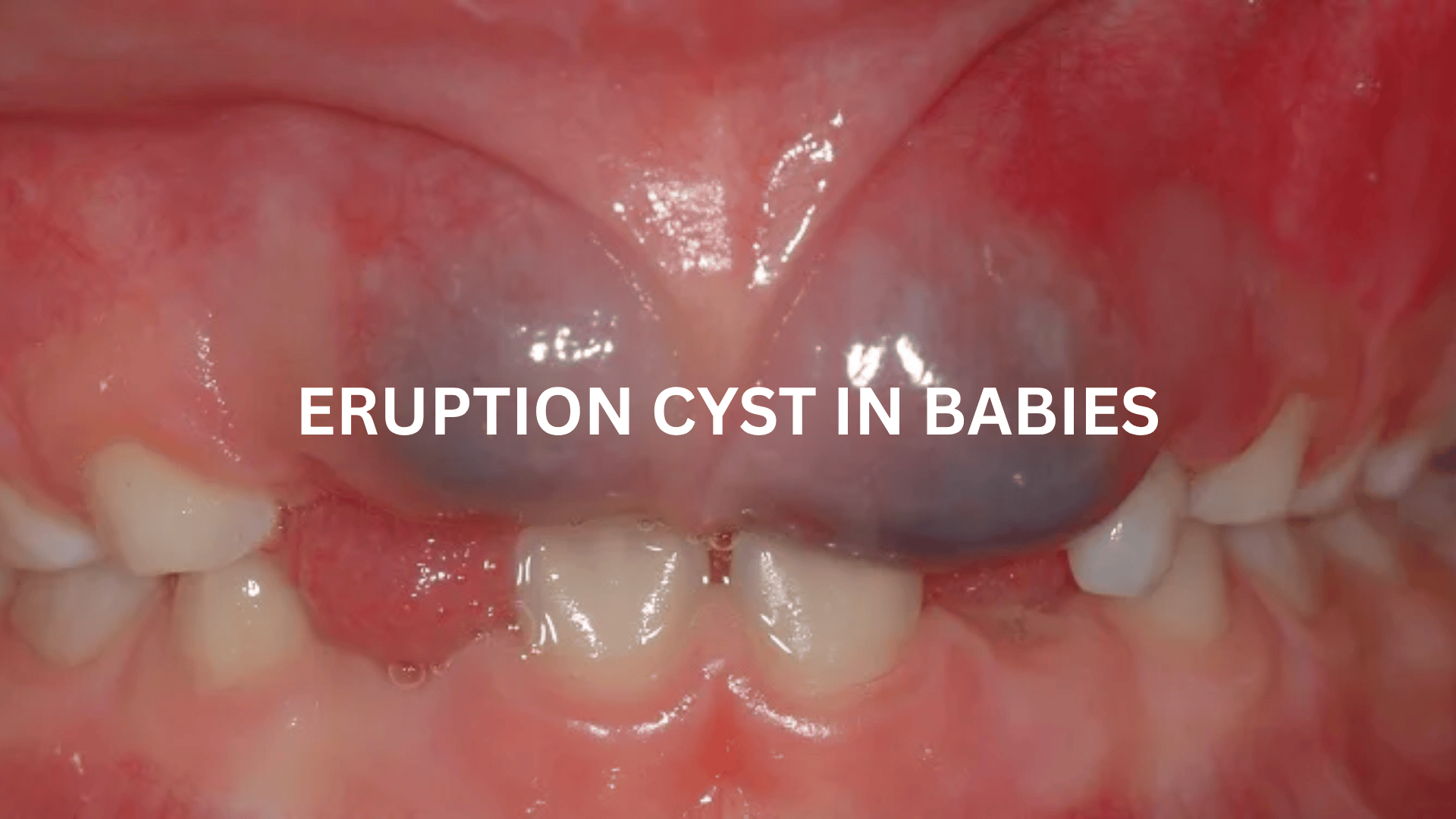 Eruption Cyst in Babies: Causes, Symptoms, & Treatment