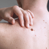 Melanoma