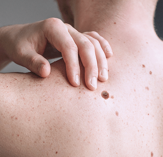 Melanoma