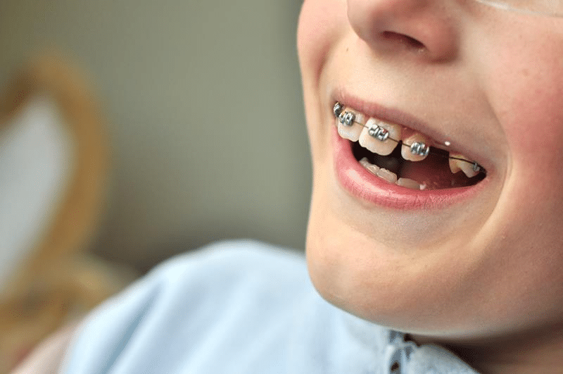 Orthodontics for Kids: Your Guide to Healthy Smiles from the Start