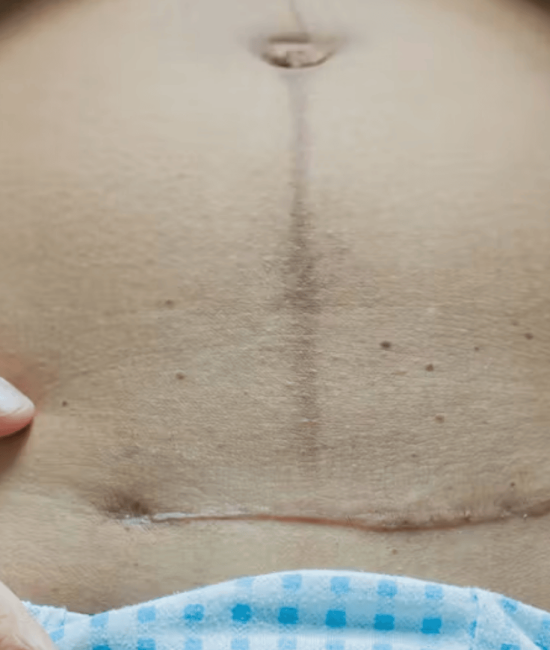 C-Section Scar Massage: Step-by-Step Healing Guide